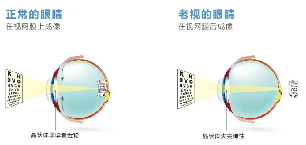 【科普】更年期遇上老花眼怎么办？多学科专家教你科学应对
