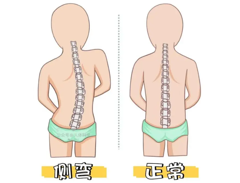 孩子驼背、高低肩？千万别忽视！可能是脊柱侧弯
